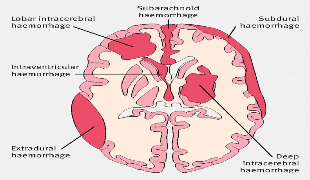 Subarachnoid Hemorrhage - What You Need to Know